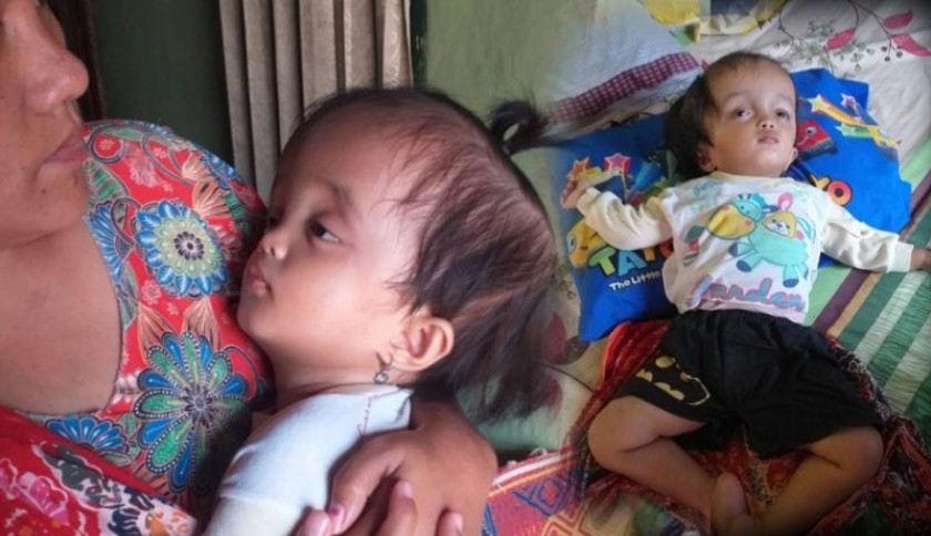 Butuh Pertolongan! Sallwa, Bocah Cantik Usia 2 Tahun Harus Menahan Sakit Akibat Hidrosefalus