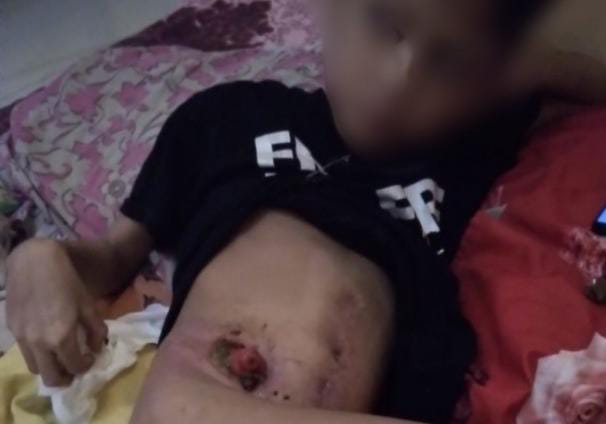 Usus Buntu Membuat Bocah SD di Pesibar Tersiksa, Orangtua Bingung Harus Bagaimana